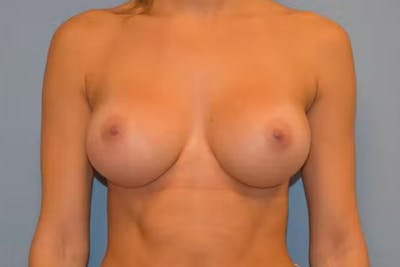 Breast Augmentation Before & After Gallery - Patient 114525 - Image 2