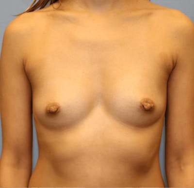 Breast Augmentation Before & After Gallery - Patient 373900 - Image 1