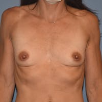 Breast Augmentation Before & After Gallery - Patient 140577 - Image 1