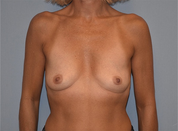 Breast Augmentation Before & After Gallery - Patient 257461 - Image 1