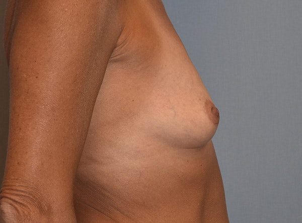 Breast Augmentation Before & After Gallery - Patient 257461 - Image 5