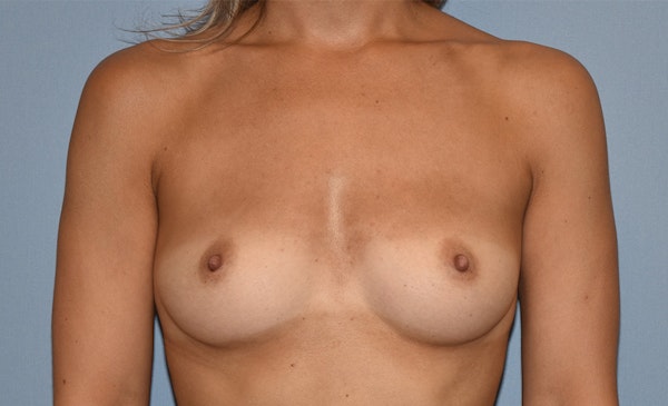 Breast Augmentation Before & After Gallery - Patient 296543 - Image 1