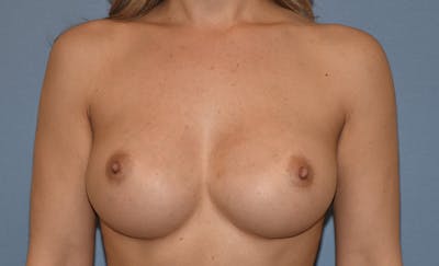 Breast Augmentation Before & After Gallery - Patient 296543 - Image 2