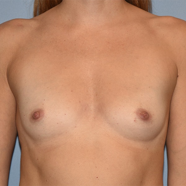Breast Augmentation Before & After Gallery - Patient 278098 - Image 1