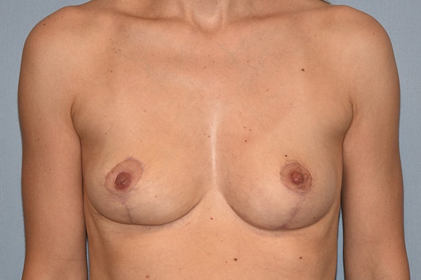 Breast Reduction Before & After Gallery - Patient 224412 - Image 2