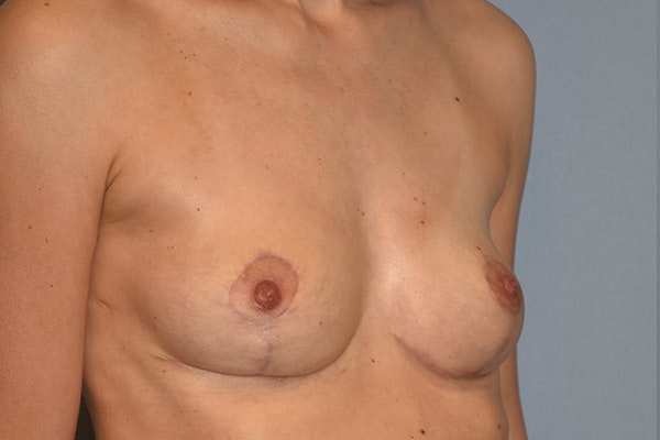 Breast Reduction Before & After Gallery - Patient 224412 - Image 4