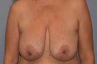 Breast Reduction Before & After Gallery - Patient 161766 - Image 1