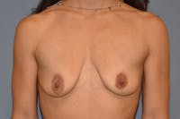 Breast Augmentation Lift Before & After Gallery - Patient 368120 - Image 1