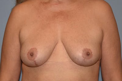 Breast Reduction Before & After Gallery - Patient 161766 - Image 2