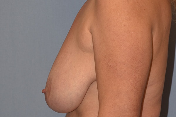 Breast Reduction Before & After Gallery - Patient 161766 - Image 5