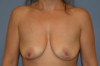 Breast Lift Before & After Gallery - Patient 208110 - Image 1