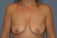 Breast Lift Before & After Gallery - Patient 409954 - Image 1