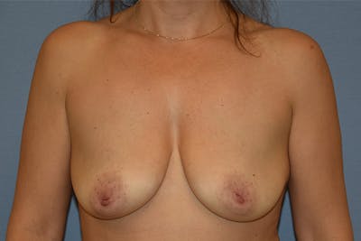 Breast Lift Before & After Gallery - Patient 208110 - Image 1