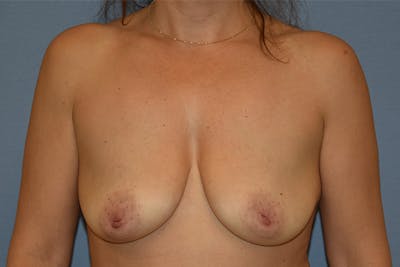 Breast Lift Before & After Gallery - Patient 409954 - Image 1