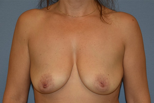 Breast Lift Before & After Gallery - Patient 409954 - Image 1