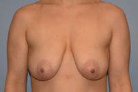 Breast Reduction Before & After Gallery - Patient 187275 - Image 1