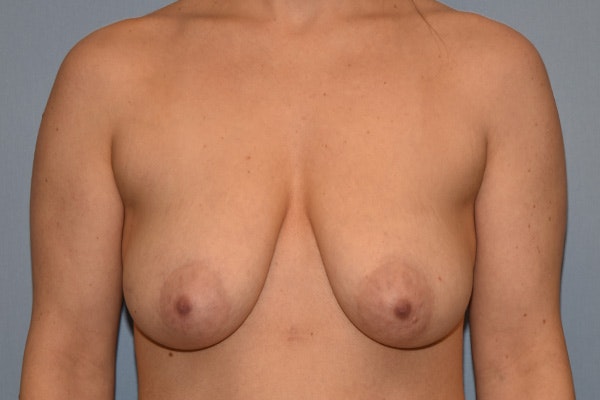 Breast Reduction Before & After Gallery - Patient 187275 - Image 1