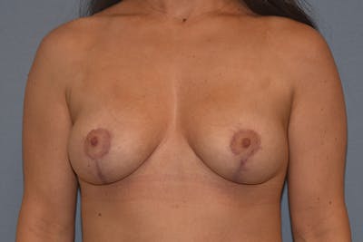 Breast Reduction Before & After Gallery - Patient 187275 - Image 2