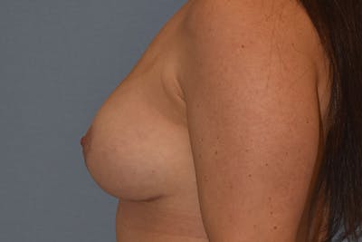 Breast Reduction Before & After Gallery - Patient 187275 - Image 6