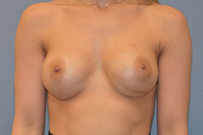 Breast Revision Before & After Gallery - Patient 369550 - Image 1