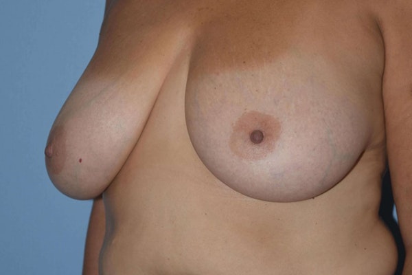 Breast Lift Before & After Gallery - Patient 739507 - Image 3