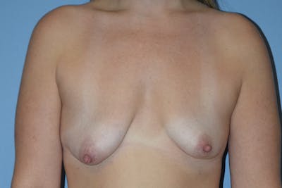 Breast Augmentation Lift Before & After Gallery - Patient 313793 - Image 1