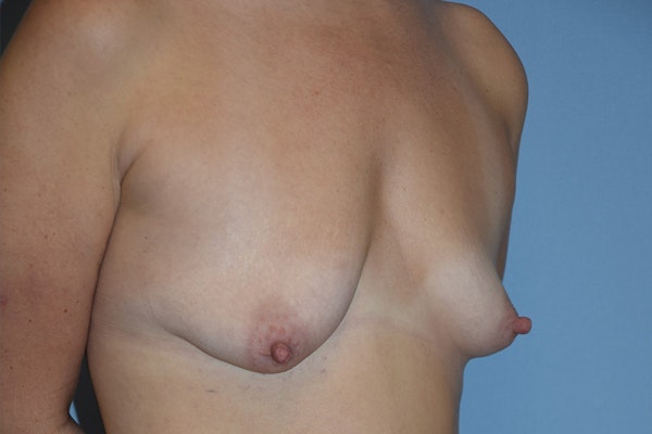 Breast Augmentation Lift Before & After Gallery - Patient 313793 - Image 3