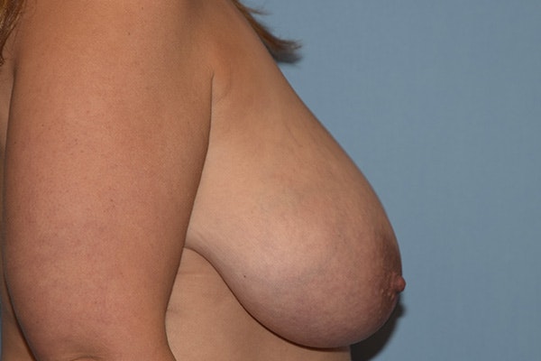 Breast Reduction Before & After Gallery - Patient 542667 - Image 5