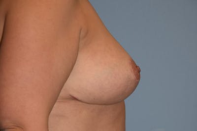 Breast Reduction Before & After Gallery - Patient 542667 - Image 6