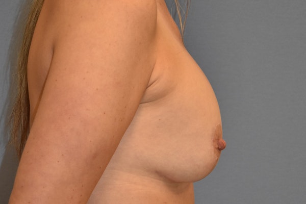 Breast Augmentation Lift Before & After Gallery - Patient 313793 - Image 6