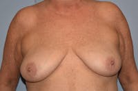 Breast Reconstruction Before & After Gallery - Patient 300132 - Image 1