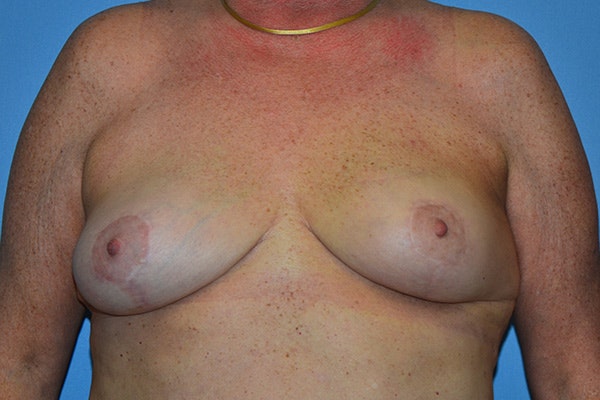 Breast Reconstruction Before & After Gallery - Patient 300132 - Image 2