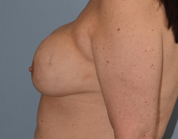 Breast Revision Before & After Gallery - Patient 250213 - Image 7