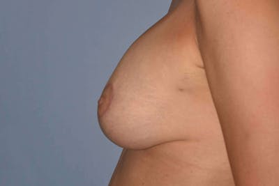 Breast Augmentation Lift Before & After Gallery - Patient 115319 - Image 6