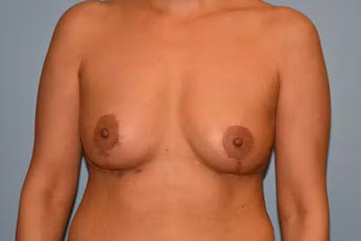 Breast Implant Removal Before & After Gallery - Patient 254266 - Image 2