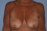 Breast Augmentation Lift Before & After Gallery - Patient 366654 - Image 1