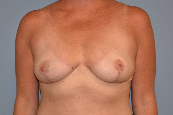 Breast Reduction Before & After Gallery - Patient 153418 - Image 2