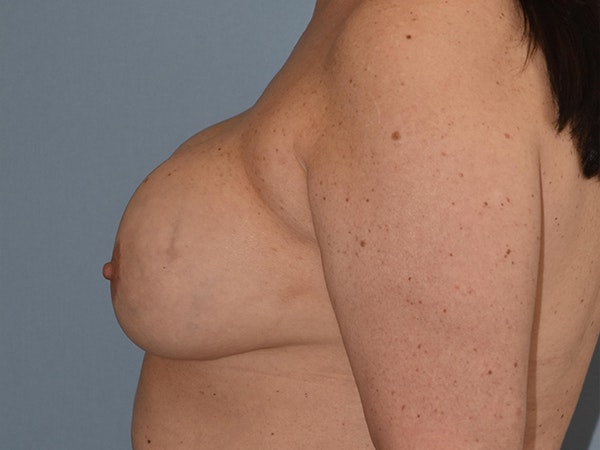 Breast Lift Before & After Gallery - Patient 259196 - Image 5
