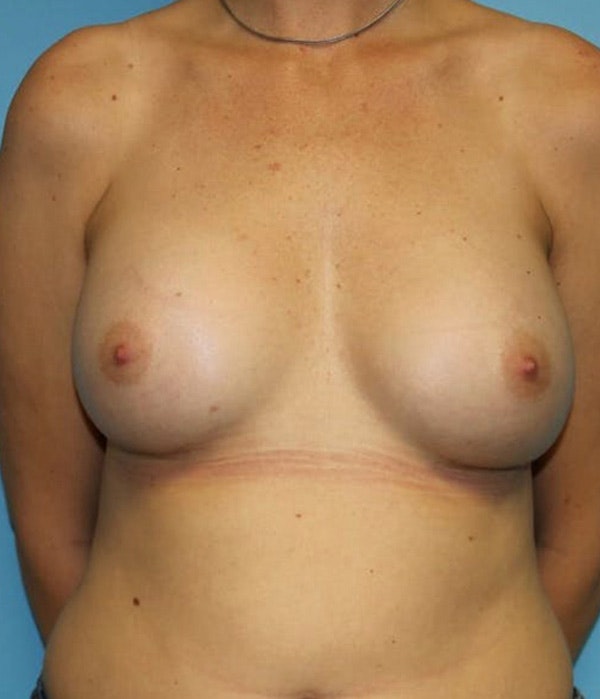 Breast Revision Before & After Gallery - Patient 179104 - Image 2
