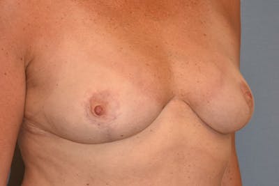 Breast Reduction Before & After Gallery - Patient 153418 - Image 4