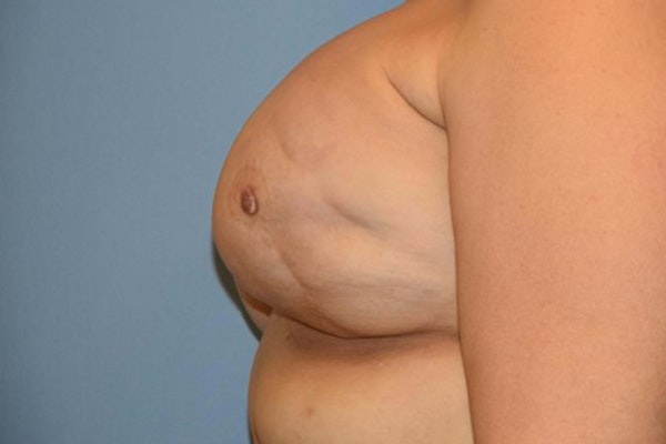 Breast Reconstruction Before & After Gallery - Patient 220605 - Image 5