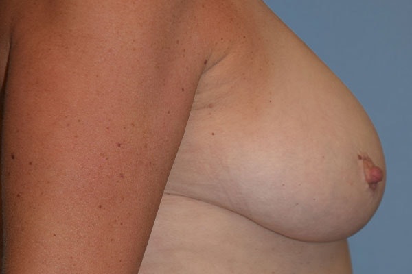 Breast Reduction Before & After Gallery - Patient 153418 - Image 5