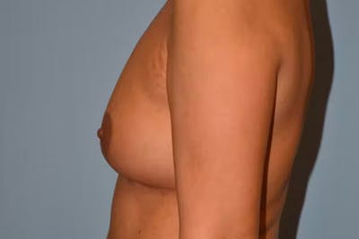 Breast Implant Removal Before & After Gallery - Patient 254266 - Image 6