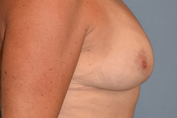 Breast Reduction Before & After Gallery - Patient 153418 - Image 6