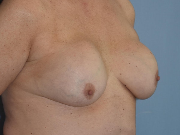 Breast Lift Before & After Gallery - Patient 259196 - Image 7