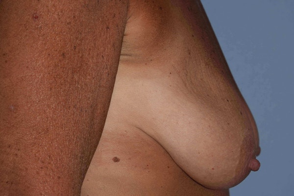Breast Augmentation Lift Before & After Gallery - Patient 366654 - Image 5