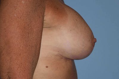 Breast Augmentation Lift Before & After Gallery - Patient 366654 - Image 6