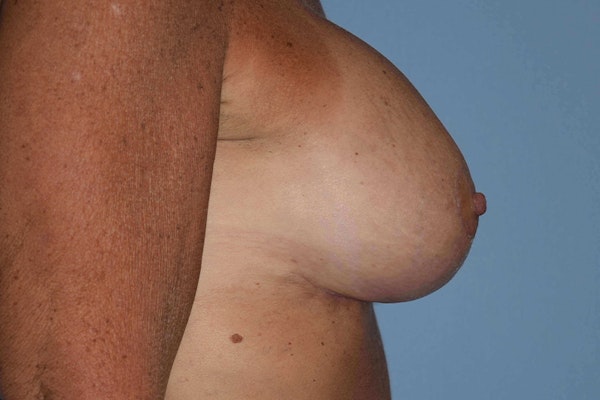 Breast Augmentation Lift Before & After Gallery - Patient 366654 - Image 6