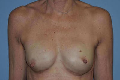 Breast Reconstruction Before & After Gallery - Patient 226686 - Image 2