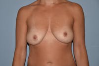 Breast Augmentation Lift Before & After Gallery - Patient 414215 - Image 1